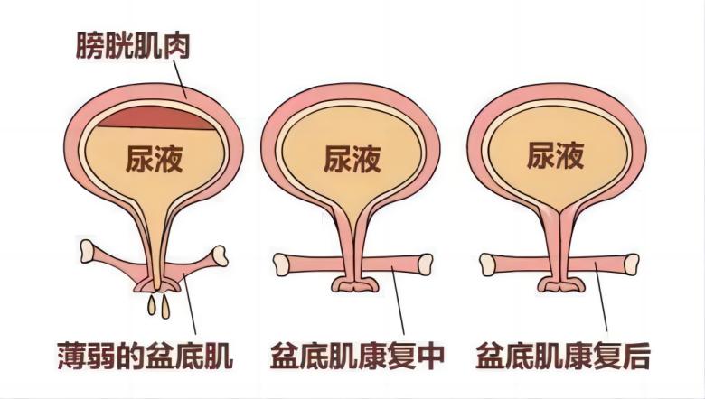 九游NING医疗丨如何有效运用振动提高盆底肌肉激活水平？